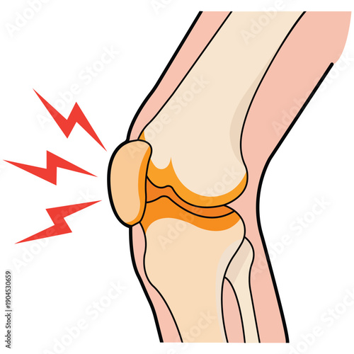 Knee Pain: An illustration of a knee joint experiencing pain, showing red lightning bolts emanating from the afflicted area and showcasing a visual representation of discomfort.