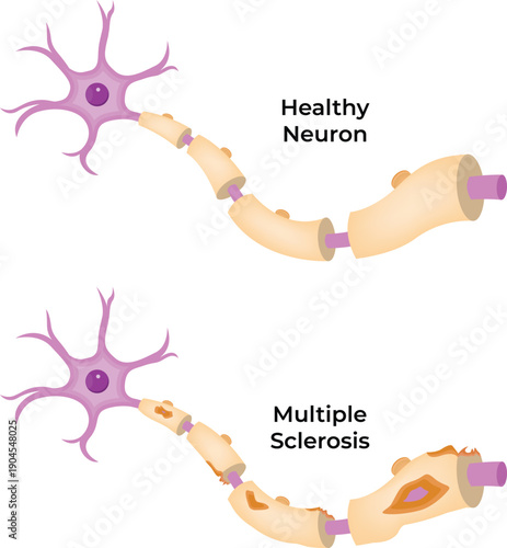 Healthy Neuron vs Multiple Sclerosis Demyelination Comparison
