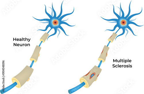 Comparison of Healthy Neuron and Multiple Sclerosis Neuron