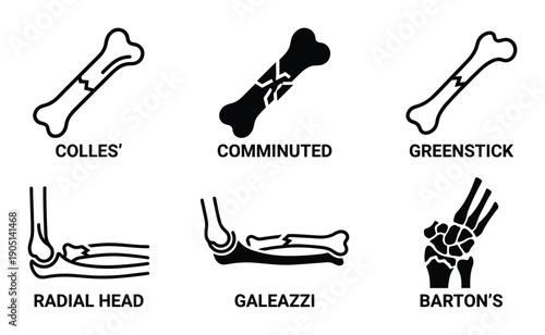 Bone fracture types Colles, comminuted, greenstick, radial head, Galeazzi, Barton's, various diagrams of bone fractures