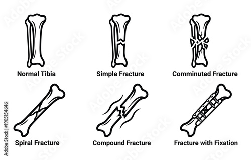 Types of Tibia Fractures Diagram: Normal, Simple, Comminuted, Spiral, Compound, Fracture with Fixation