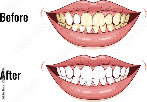 Dental before after illustration, teeth whitening artwork, oral hygiene graphic design, cosmetic dentistry vector, smile improvement icon pack, black and white comparison