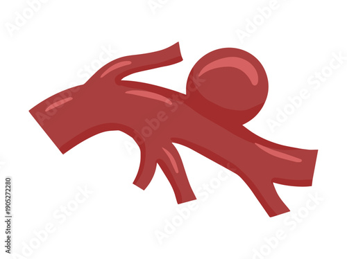 Saccular Aneurysm Blood Vessel
