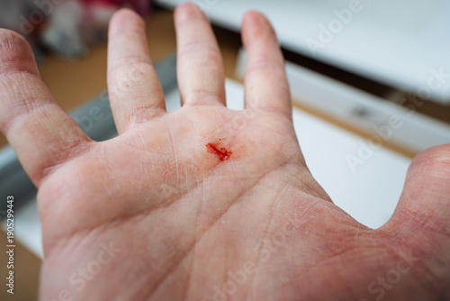Close View Of Hand Wound. Focus On Hand Injury With Careful Blood Examination And Sterile Setting. Closeup Of Caucasian Hand Showing Fresh Wound And Meticulous Sterile Medical Assessment