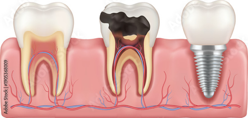 3D vector medical illustration showing healthy tooth decayed tooth with cavity and dental implant with screw in pink gums isolated Professional dentistry education concept for healthcare advertisement