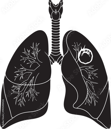 Human lungs anatomy illustration with tumor isolated on transparent background