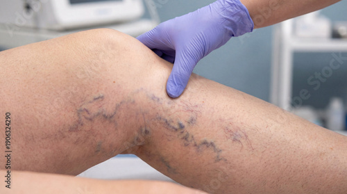 Close-up of a medical professional's gloved hand examining a patient's leg with visible varicose veins