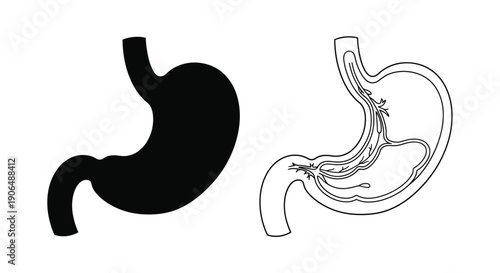Anatomical illustration comparing a normal and diseased human stomach
