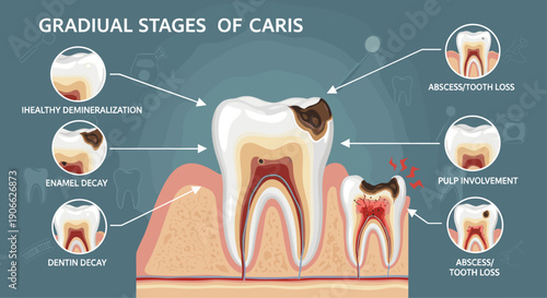A detailed medical illustration on a dark blue background vividly displays the gradual stages of dental caries progression from initial demineralization to severe tooth decay and eventual tooth loss.
