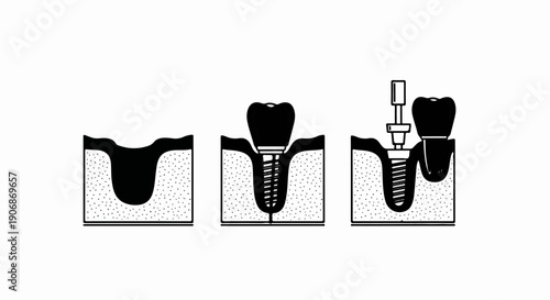 Diagram shows bone preparation for dental implant and placement process