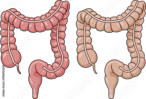 Large intestine anatomy comparison illustration showing healthy colon and diseased colon, medical diagram of digestive system, bowel structure for healthcare education