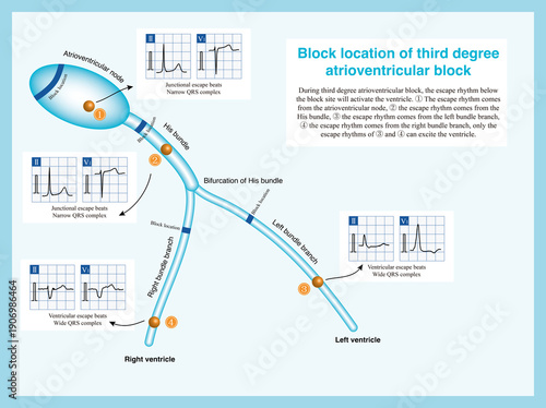 Third degree atrioventricular block can occur in the atrioventricular node, His bundle, and bundle branches, and only the escape rhythm from below the block layer can excite the ventricle.
