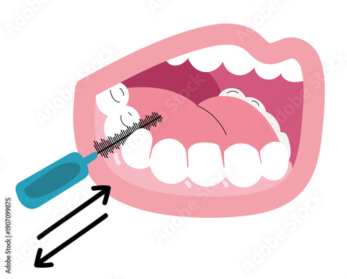 Illustration pédagogique de l’utilisation d’une brossette interdentaire pour nettoyer les espaces entre les dents et prévenir les maladies parodontales