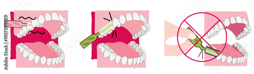 Illustration pédagogique montrant les problèmes liés à une mauvaise utilisation des brossettes interdentaires