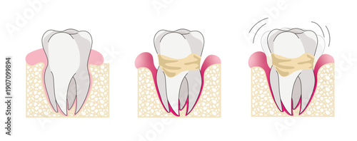 Illustration pédagogique sur la parodontie, l’inflammation des gencives et les maladies parodontales