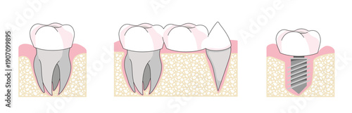 Illustration explicative présentant différents types d’implants dentaires et solutions de remplacement des dents