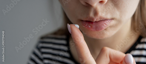 Tablou pe pânză Woman applying medical cream on herpes sore on her lip - virus treatment concept