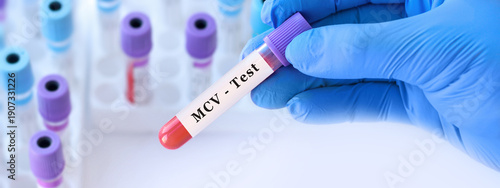 Doctor holding blood sample tube with MCV test, mean corpuscular volume analysis explaining red blood cell size for anemia detection, blood disorders diagnosis and complete blood count interpretation