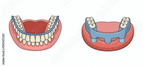 Cartoon of upper and lower dentures with blue metal framework dental teeth