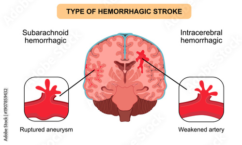 Brain stroke, hemorrhagic Intracerebral and subarachnoid. Arteriosclerosis, infarct, ischemia, thrombosis disease. Cholesterol in human blood vessels. Medical poster vector illustration.