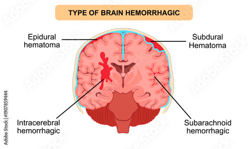 Types of brain hemorrhage. epidural hematoma, subdural hematoma, intracerebral, subarachnoid. Human brain anatomy. Vector illustration for medical, clinic, poster, and education.