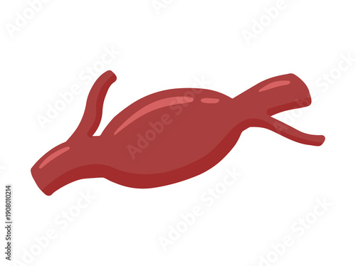 Hand Drawn Fusiform Aneurysm Blood Vessel
