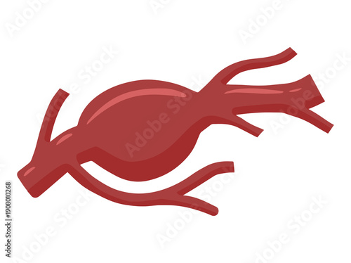 Fusiform Aneurysm Blood Vessel Clip Art