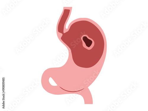 Stomach Ulcer Disease
