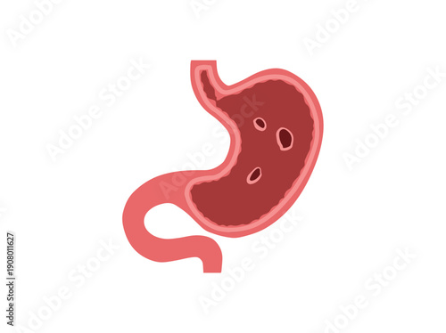 Stomach Ulcer Disease