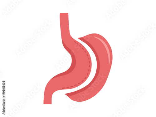 Hand Drawn Vertical Sleeve Gastrectomy Surgery
