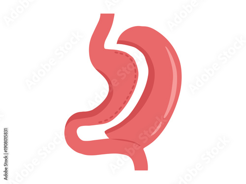 Vertical Sleeve Gastrectomy Surgery Illustration
