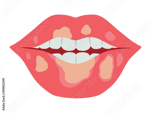 Exfoliative Cheilitis Lip Disease Illustration
