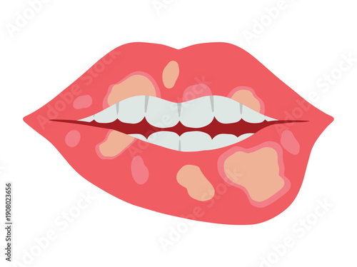 Exfoliative Cheilitis in Lip Disease