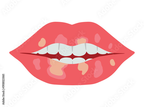 Exfoliative Cheilitis in Lip Disease
