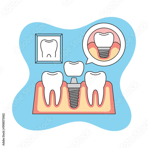 Dental implant diagram shows screw.