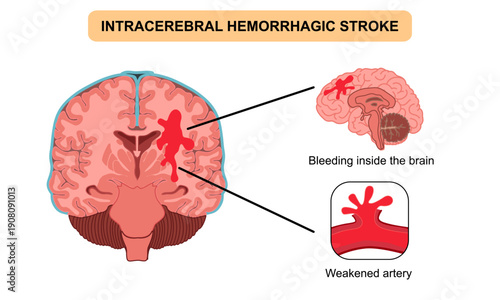 Brain stroke hemorrhagic Intracerebral. Arteriosclerosis, infarct, ischemia, thrombosis disease. Cholesterol in human blood vessels. Medical poster vector illustration.