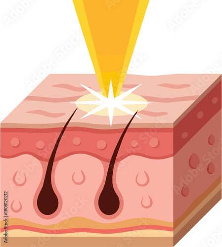 Isolated a realistic Cosmetic Laser Beam Treatment on Skin Layer Background, 3D Illustration vector art with white background.