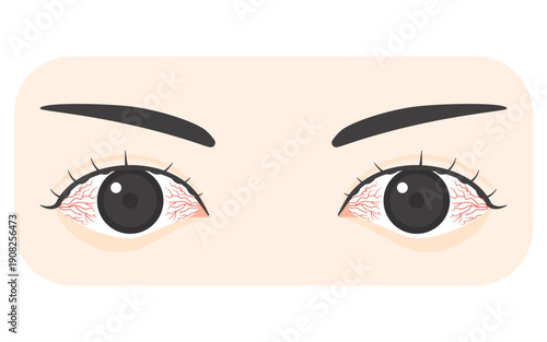 充血している目のベクターイラスト