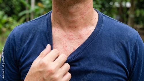 Adult white man chest with red rash and itching, close view of skin irritation outdoors, healthcare and allergy concern, summer heat discomfort and sensitive skin