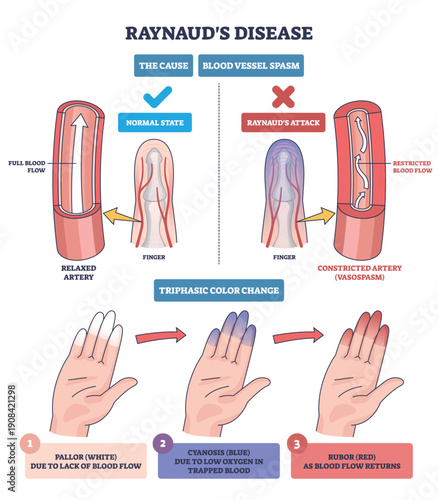 Raynauds phenomenon diagram shows finger artery spasm and triphasic hand color change, key objects, hand, finger, artery. Outline diagram