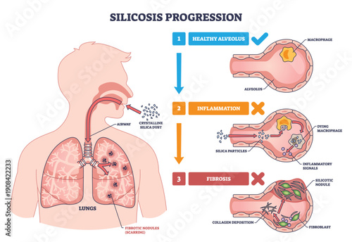 Silicosis progression shows how inhaled silica dust injures alveoli, triggering inflammation and lung fibrosis, key objects, lungs, alveolus, silica particles. Outline diagram