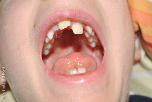 close up of dental health issues, crucket teeth 