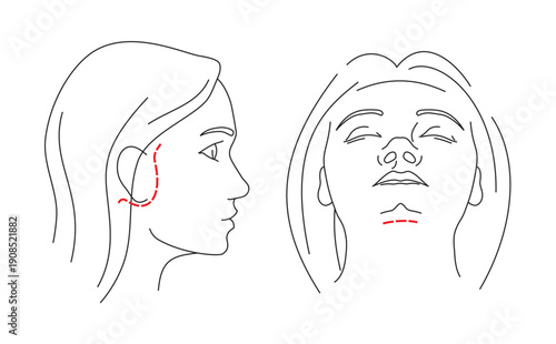 Illustrations of Facelift zones