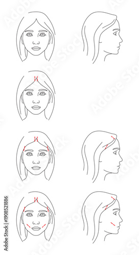 Illustrations of Facelift zones
