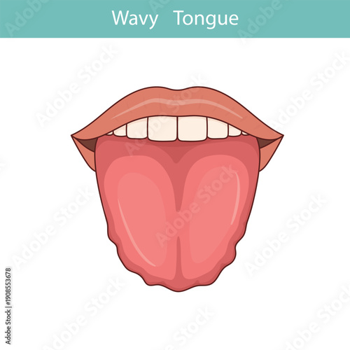 Wavy tongue disease. Medical illustration.