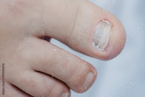 Canvas-taulu Close-up of big toe with fungal infection and nail damage after sealing with gel