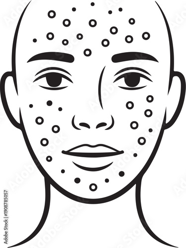 Face with acne Pimples Hand-drawn Sketch Drawing Vector Illustration, Line Linear Symbol Engraving for Coloring Book, Black and White, Isolated