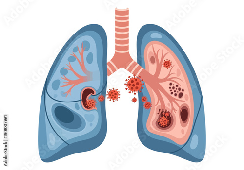 Illustration of the human lungs with virus particles damaging the tissue, representing respiratory illness and infection