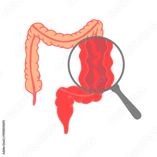 Illustration of ulcerative colitis, inflammatory bowel disease. Inflammation of the human digestive system. Flat vector illustration for medical, science, and educational posters.