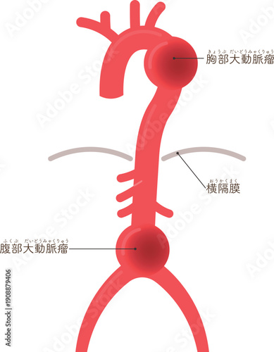 大動脈瘤のイラスト　Illustration of an aortic aneurysm